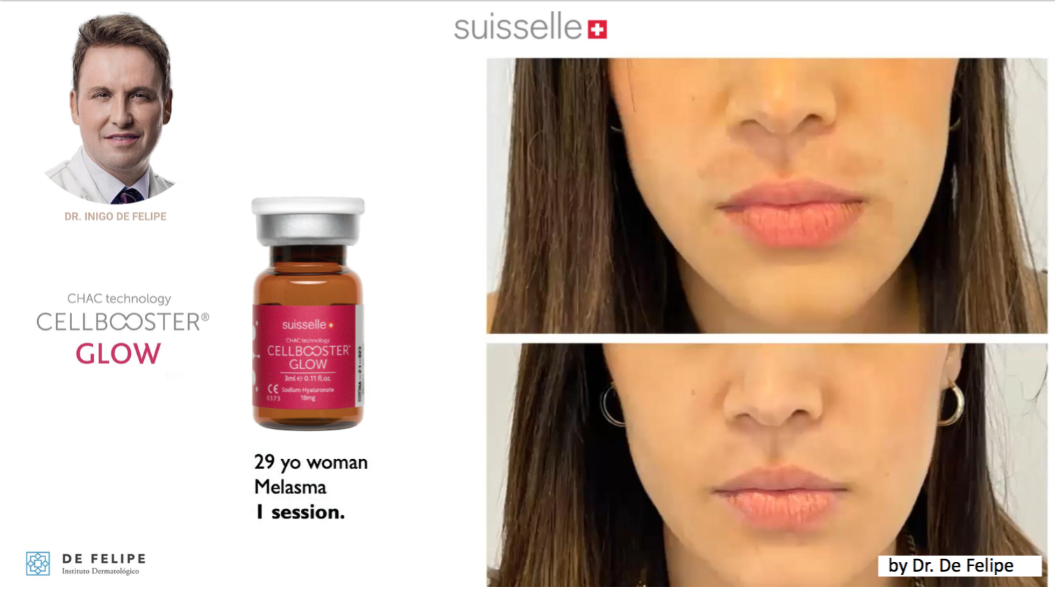 CELLBOOSTER GLOW Switzerland Hyaluronic Filler Market